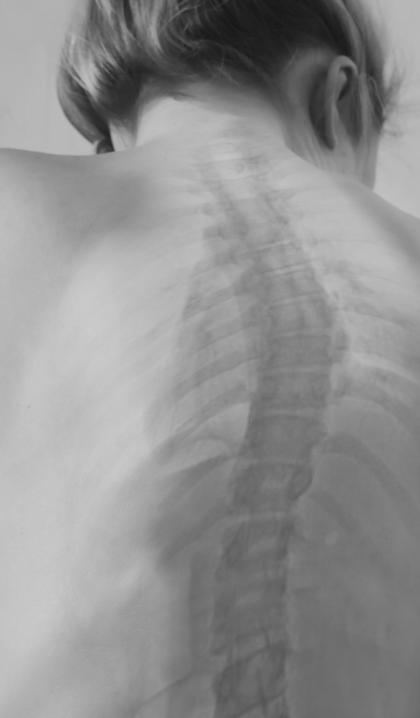 Adult Scoliosis Treatment